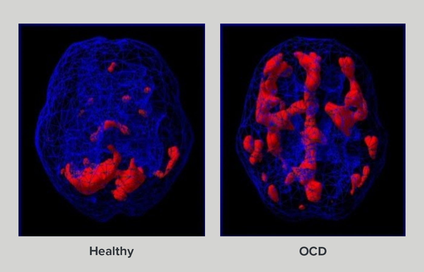 Ocd Brain