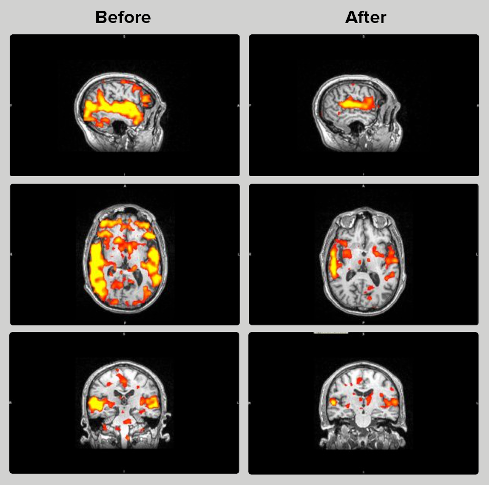 Tinnitus-before-after-fmri